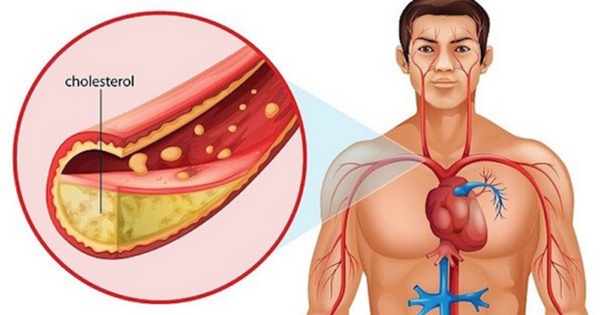 6 điều có thể dẫn đến sự gia tăng bất ngờ của Cholesterol