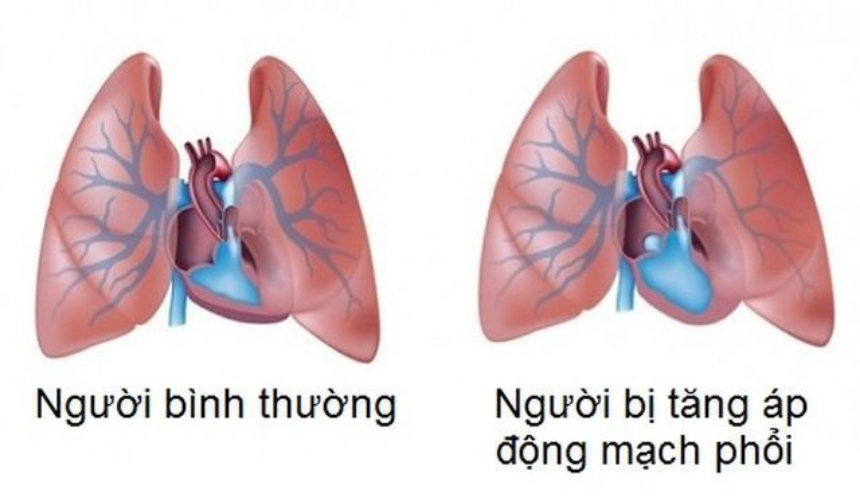 Các dấu hiệu của tăng huyết áp động mạch phổi