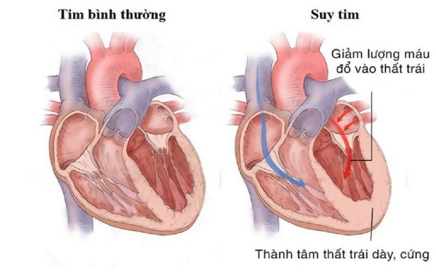 10 mẹo chăm sóc người mắc bệnh suy tim an toàn và hiệu quả