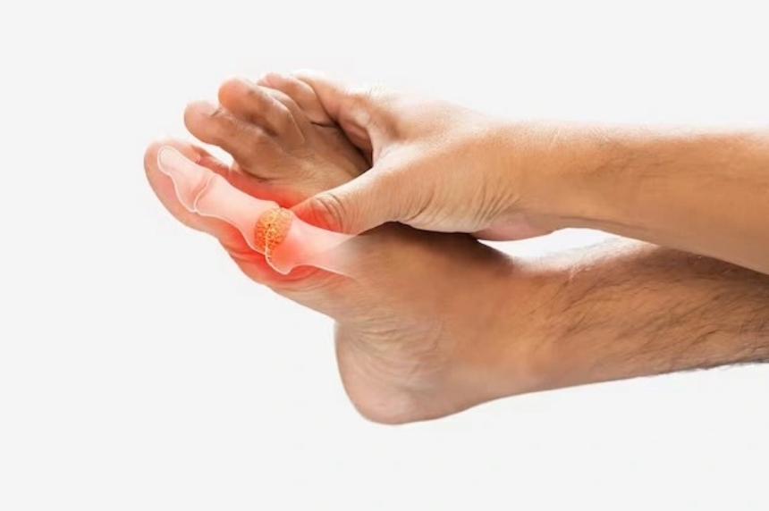 Kiểm soát và điều trị cơn bùng phát bệnh gout (gút)