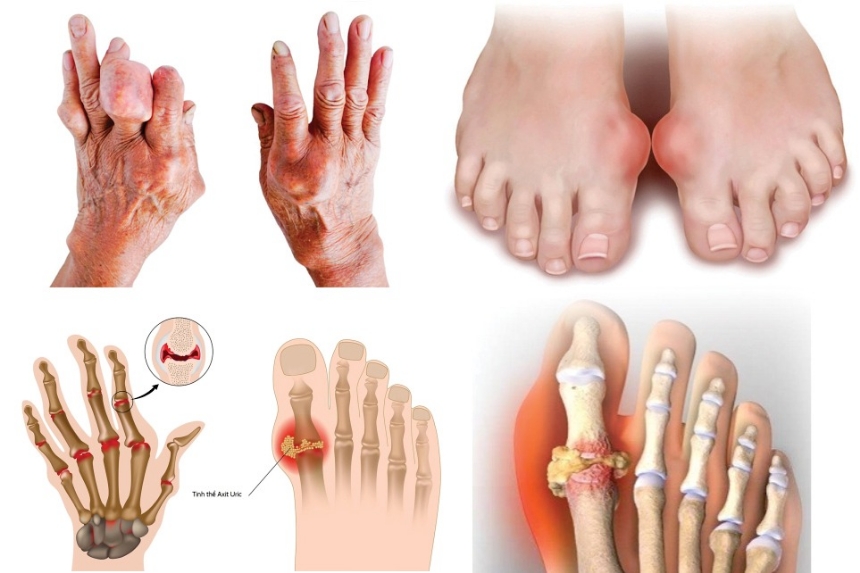 Tổng quan về bệnh gút (gout): nguyên nhân, chẩn đoán và phương pháp điều trị