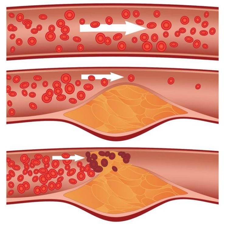 cholesterol-la-gi