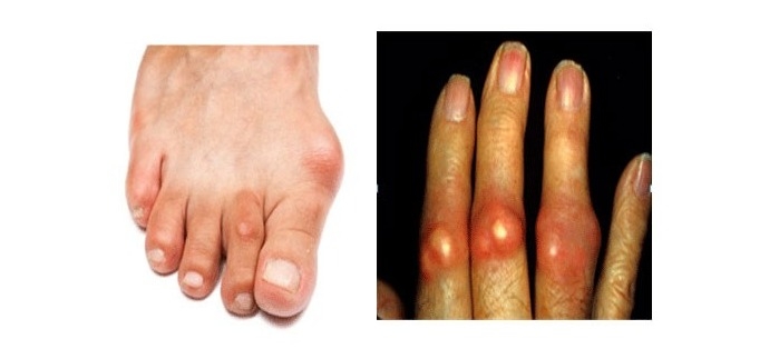 Dấu hiệu bị gout