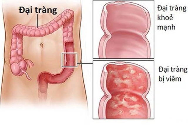 viêm loét đại tràng 